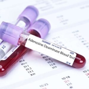 Adenosine Deaminase Blood Test