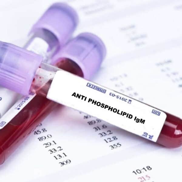 Anti Phospholipid Test