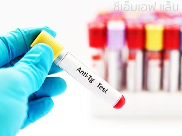 Anti TG Test