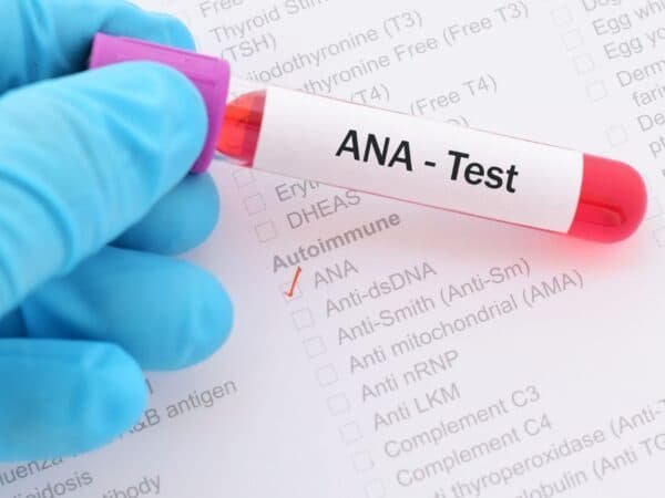 ANA ( ANTI NUCLEAR ANTIBODY)