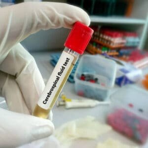 Cerebrospinal fluid test