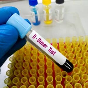 D-Dimer Test