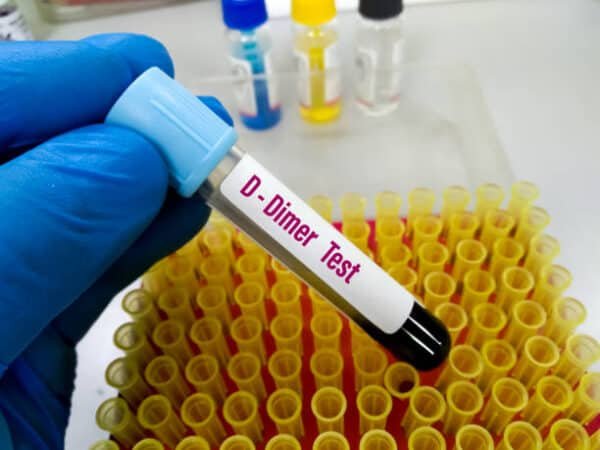 D-Dimer Test
