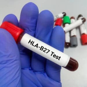 HLA - B27 Test