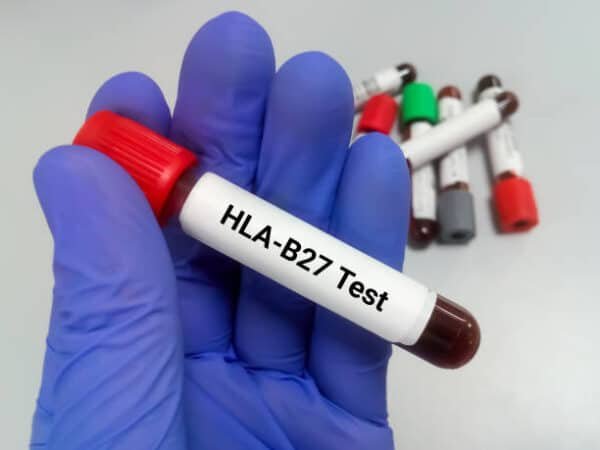 HLA - B27 Test