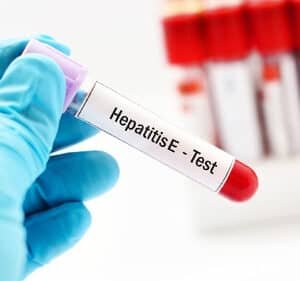 Hepatitis E Test