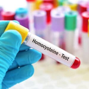 Homocysteine Serum Test