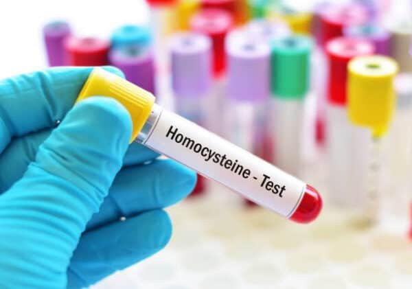 Homocysteine Serum Test