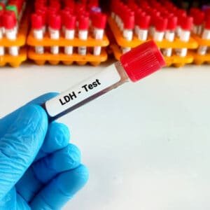 LDH Serum Test