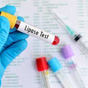 Lipase Serum Test