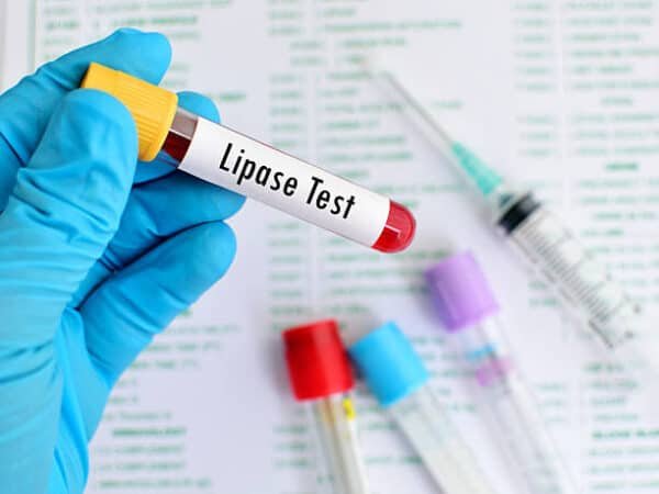 Lipase Serum Test