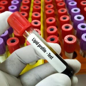 Lipid Profile Test