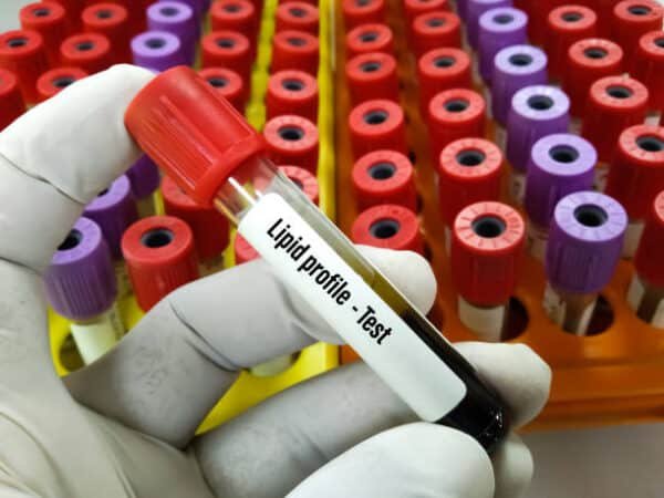 Lipid Profile Test