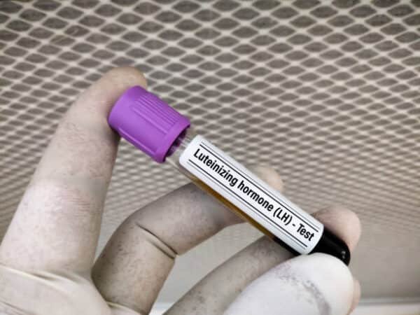 Luteinizing Hormone Test