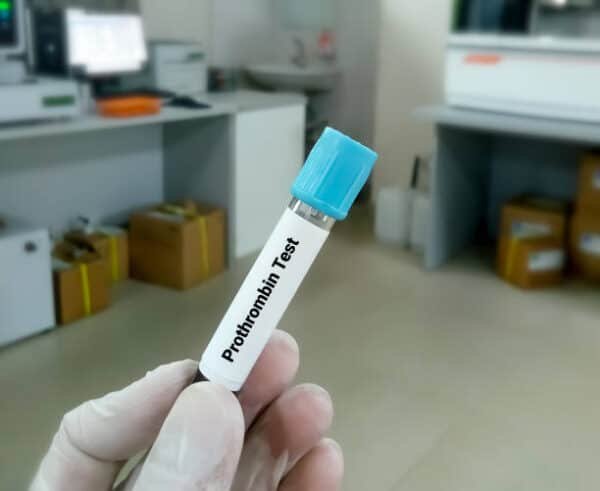 PT - Prothrombin Time Plasma Test