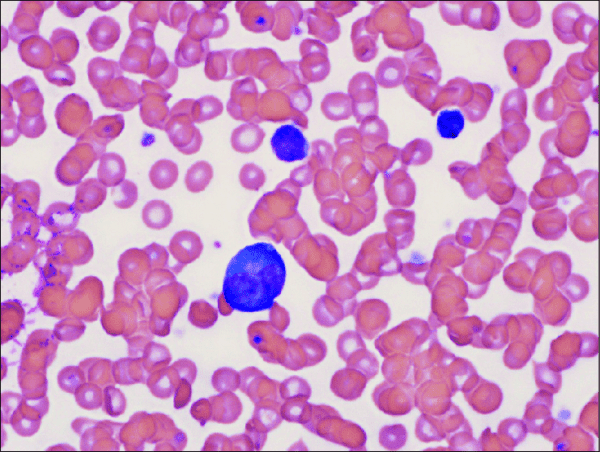 Peripheral Smear Examination