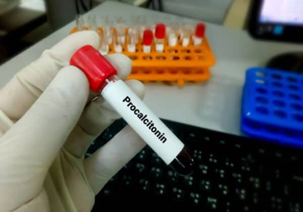 Procalcitonin Test