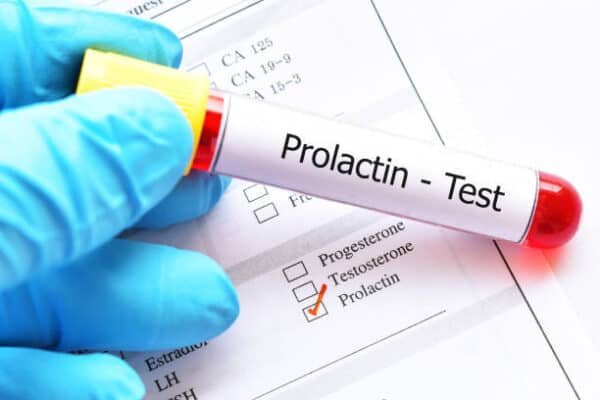 Prolactin Serum Test