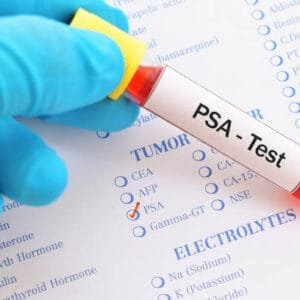 Psa Total (Prostatic Specific Antigen) Serum Test