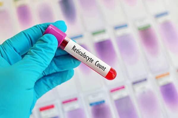 Reticulocyte Count Blood Test