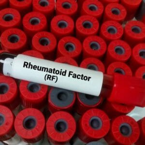 Rheumatoid Factor Test