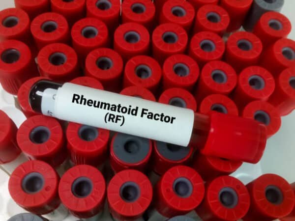 Rheumatoid Factor Test