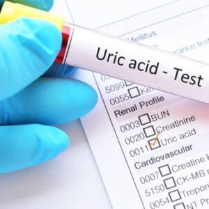 Uric Acid Serum Test