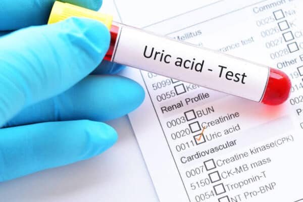 Uric Acid Serum Test