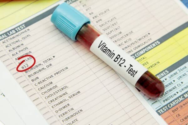 Vitamin B12 Serum Test