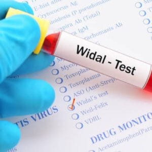 Widal Test