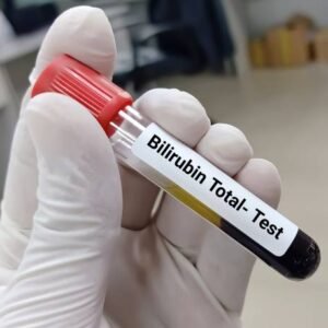 bilirubin total serum test