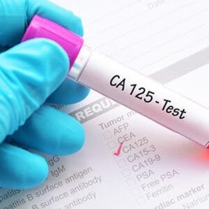 CA 125 Marker Test