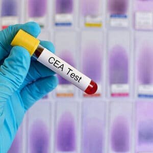 cea carcinoembryonic antigen test