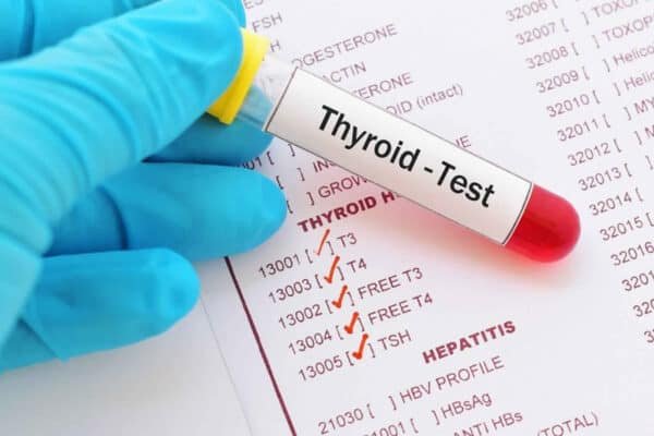 thyroid peroxidase antibody test